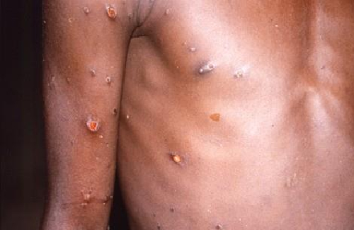 최근 원숭이두창 확산이 유럽에서 열린 두 차례 대규모 광란의 파티에서 발생한 것으로 보인다는 세계보건기구 WHO 고문의 분석이 나왔다. /사진=연합뉴스