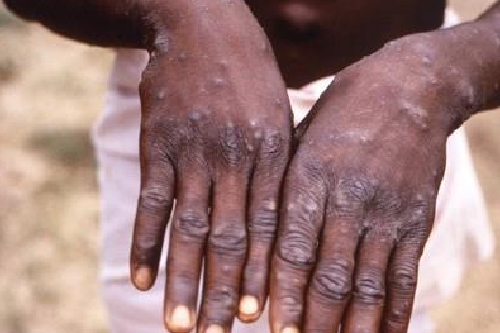 '원숭이두창'이 전 세계적으로 퍼지는 상황에서 중국 소셜미디어에서는 미국이 의도적으로 원숭이두창을 퍼뜨렸다는 음모론이 퍼지고 있다./사진=연합뉴스