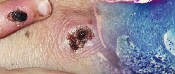 원숭이두창의 감염경로가 불분명하다는 소식이다./사진=채널A 뉴스룸 유튜브 캡쳐